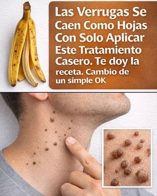Las Verrugas Se Caen Como Hojas Con Solo Aplicar Este Tratamie… ver mas