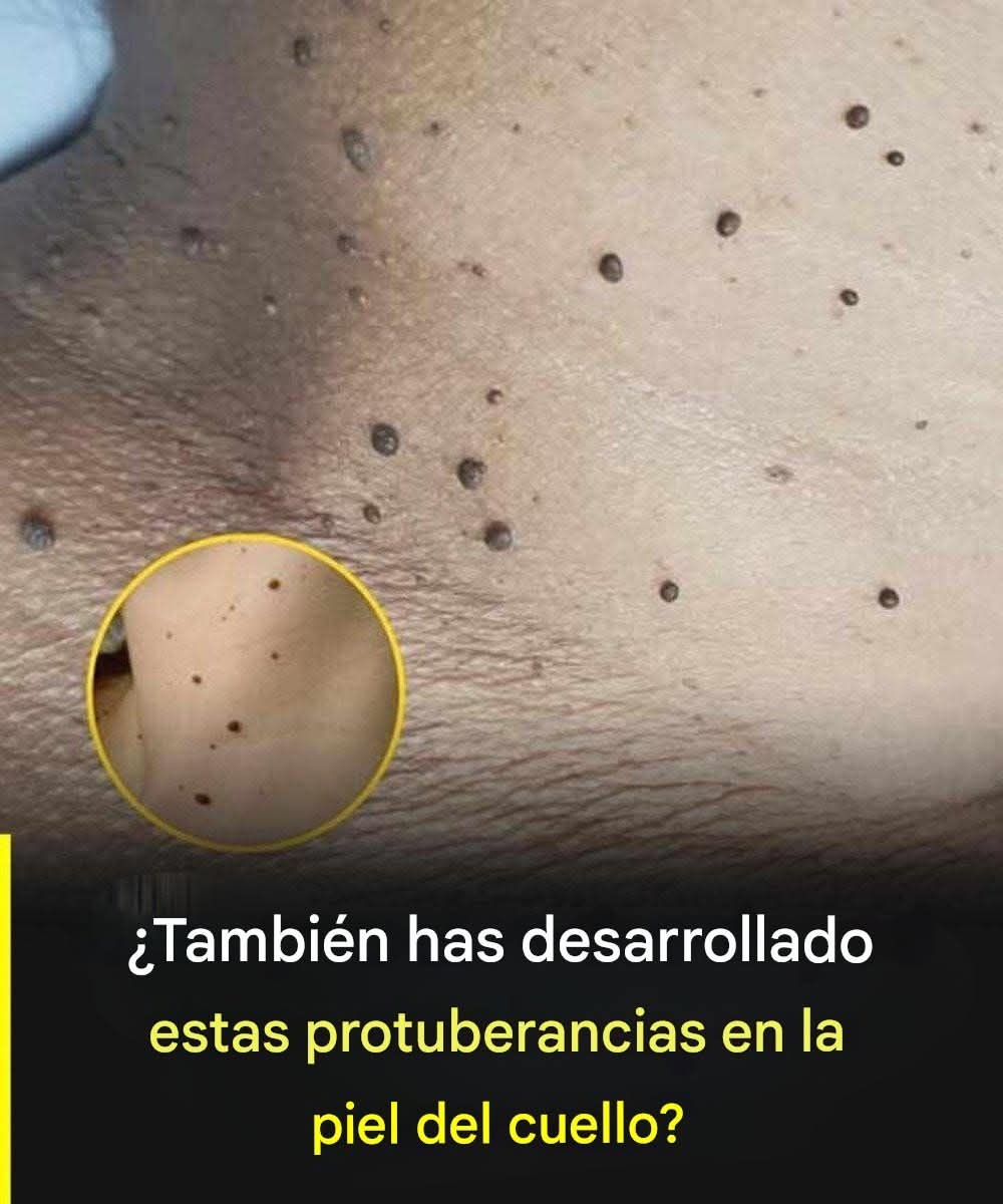 Si has notado estos pequeños granitos de piel en tu cuello o axilas es porque… Ver más