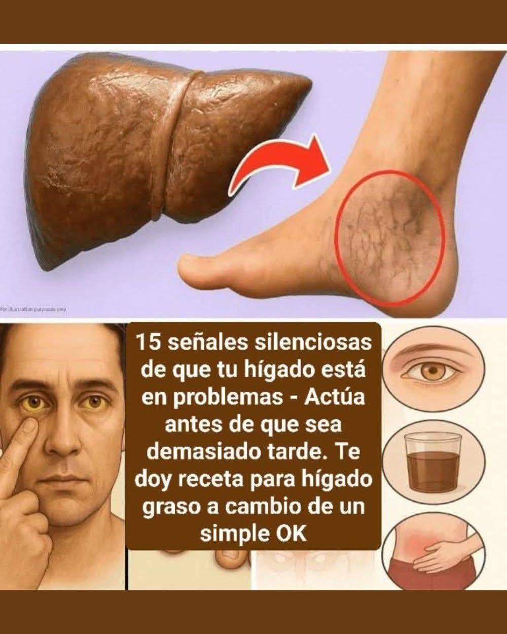 Principales Síntomas del Hígado Graso: Señales que No Debes Ignorar..ver mas