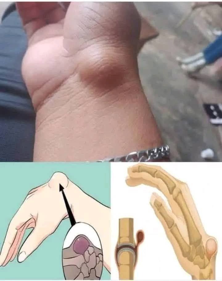 😳Si Tienes este Bulto en la Muñeca y Aparece Cuando…Ver más