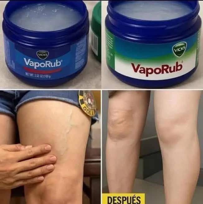 Tengo 35 años y mis piernas estaban llenas de várices 😱 pero esta receta…Ver mas