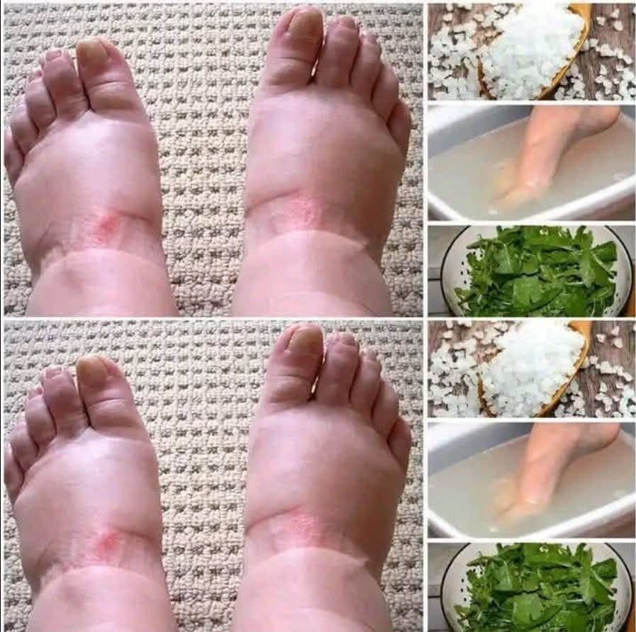 Sabías que los pies hinchados pu… Ver más