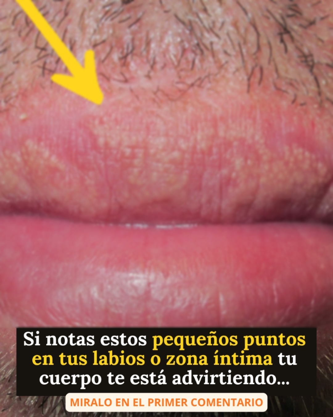 Si te están saliendo estos granitos en tus labios o zona intima es porque… Ver más