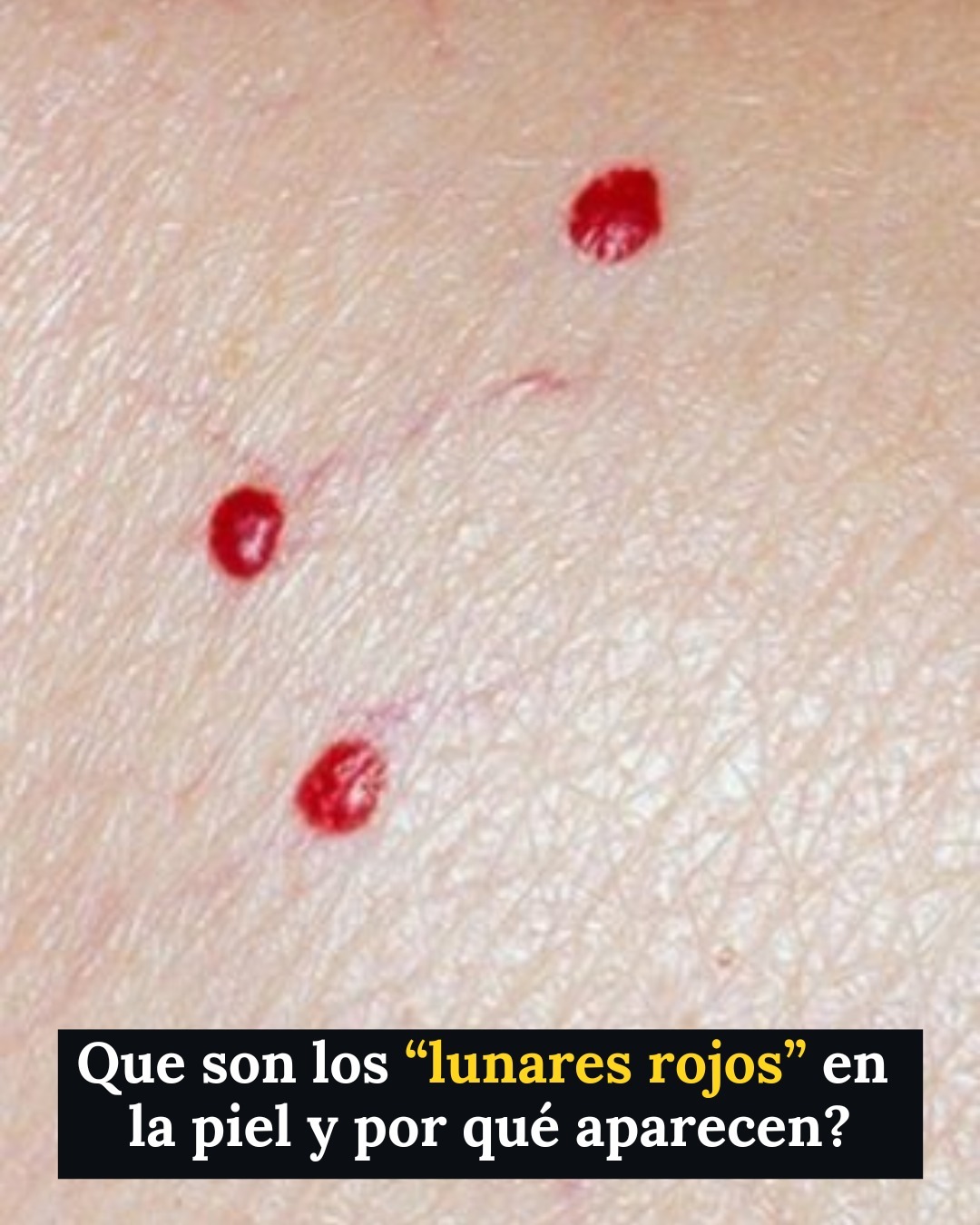 Estos puntos en la piel pueden indicar que… Ver más