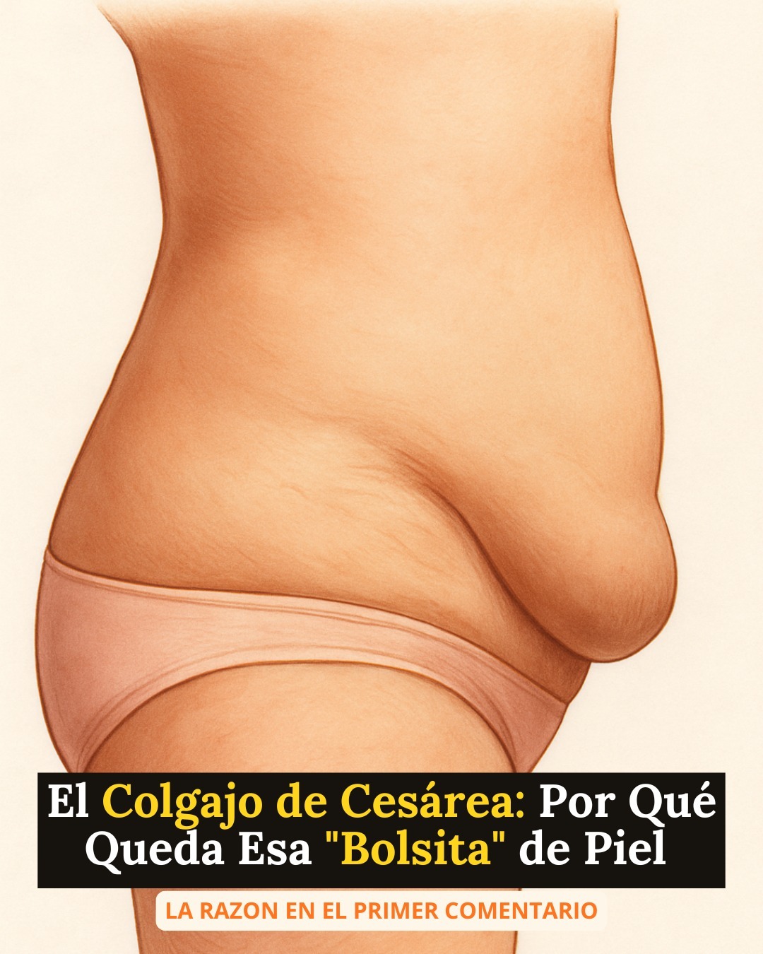 Si te quedó esa “bolsita” de piel después de la cesárea… Ver más