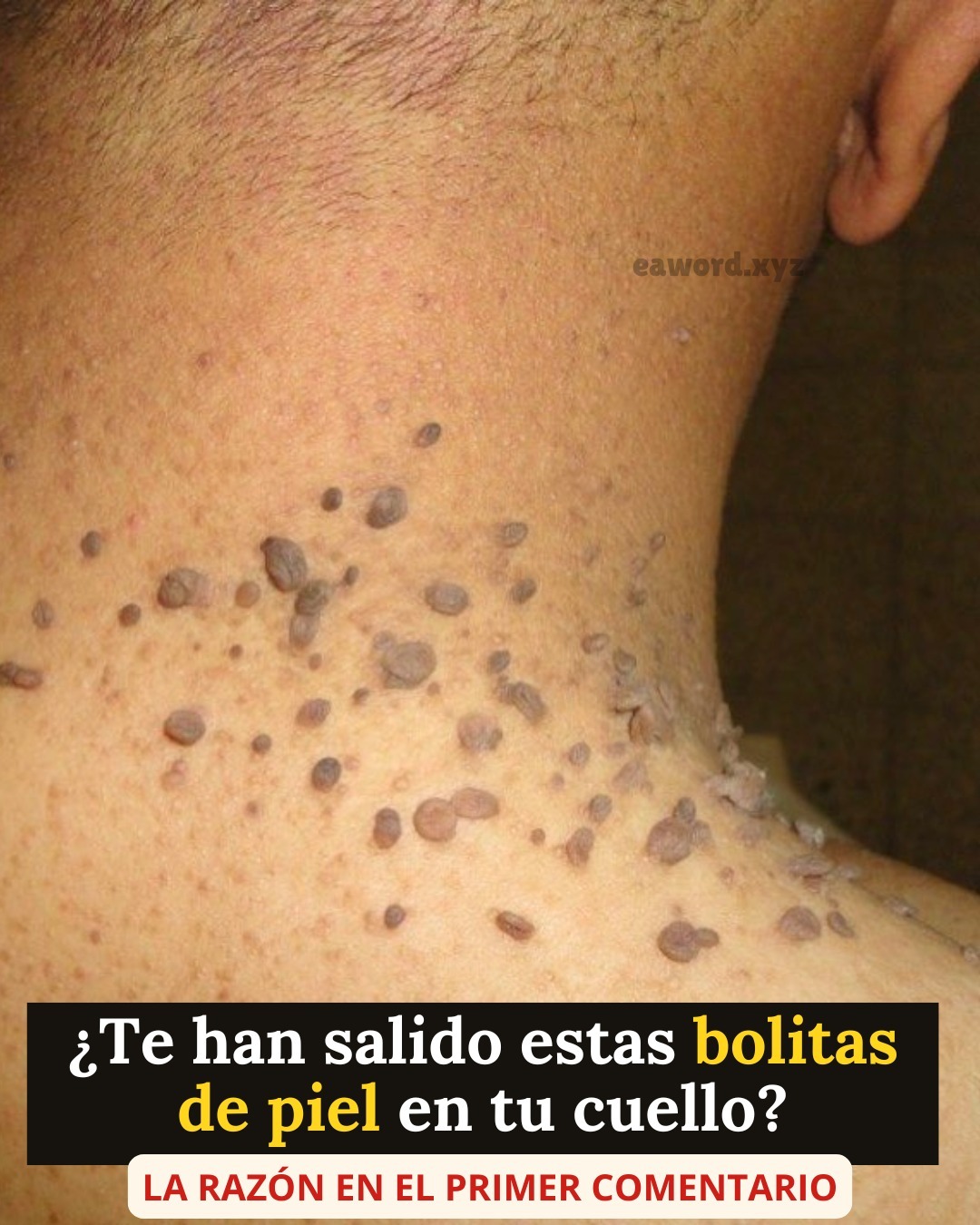 Si te has notado estas pequeñas bolitas de piel en tu cuello o axilas es que… Ver más