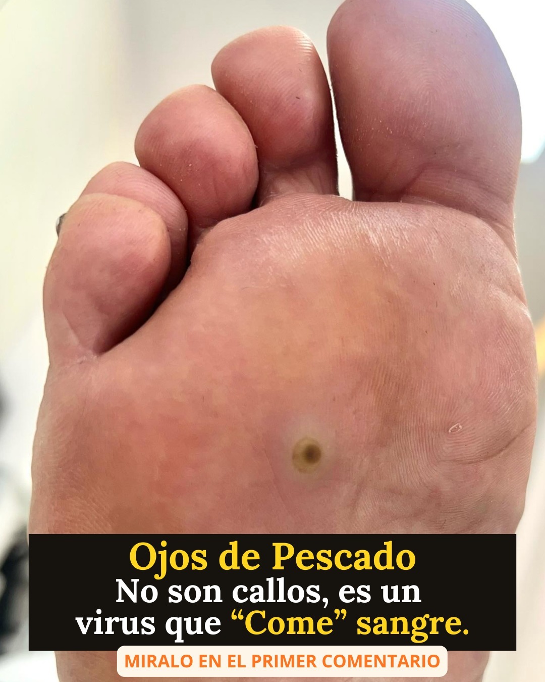 Cuando te sale un «Ojo de Pescado» no es un callo común, este crea raíces y te… Ver Más…