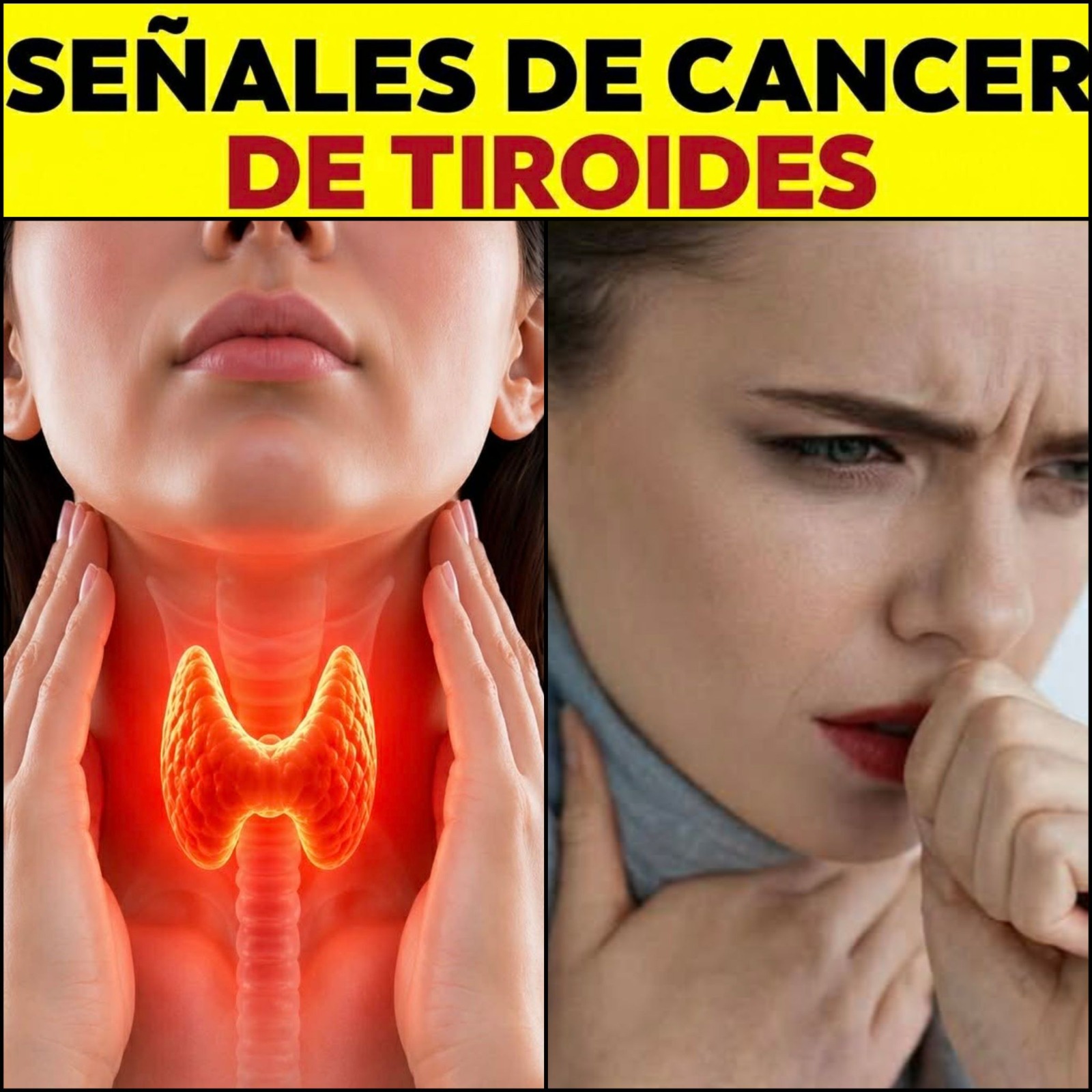 Estos son los primeros signos del cąncer de Tiroides que igno… Ver más