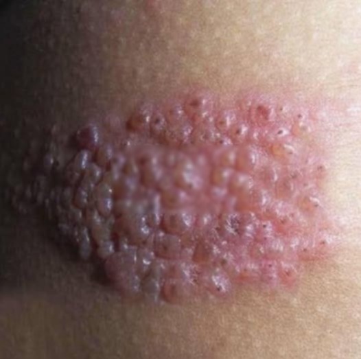 Asi es el herpes Zóster, enfermedad que se activa al someter el cuerpo a muc…Ver más