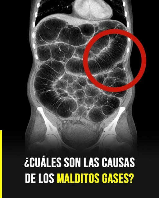 Tienes muchos gases y nadie te lo explica bien… Ver más